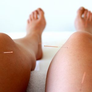 Acupuntura